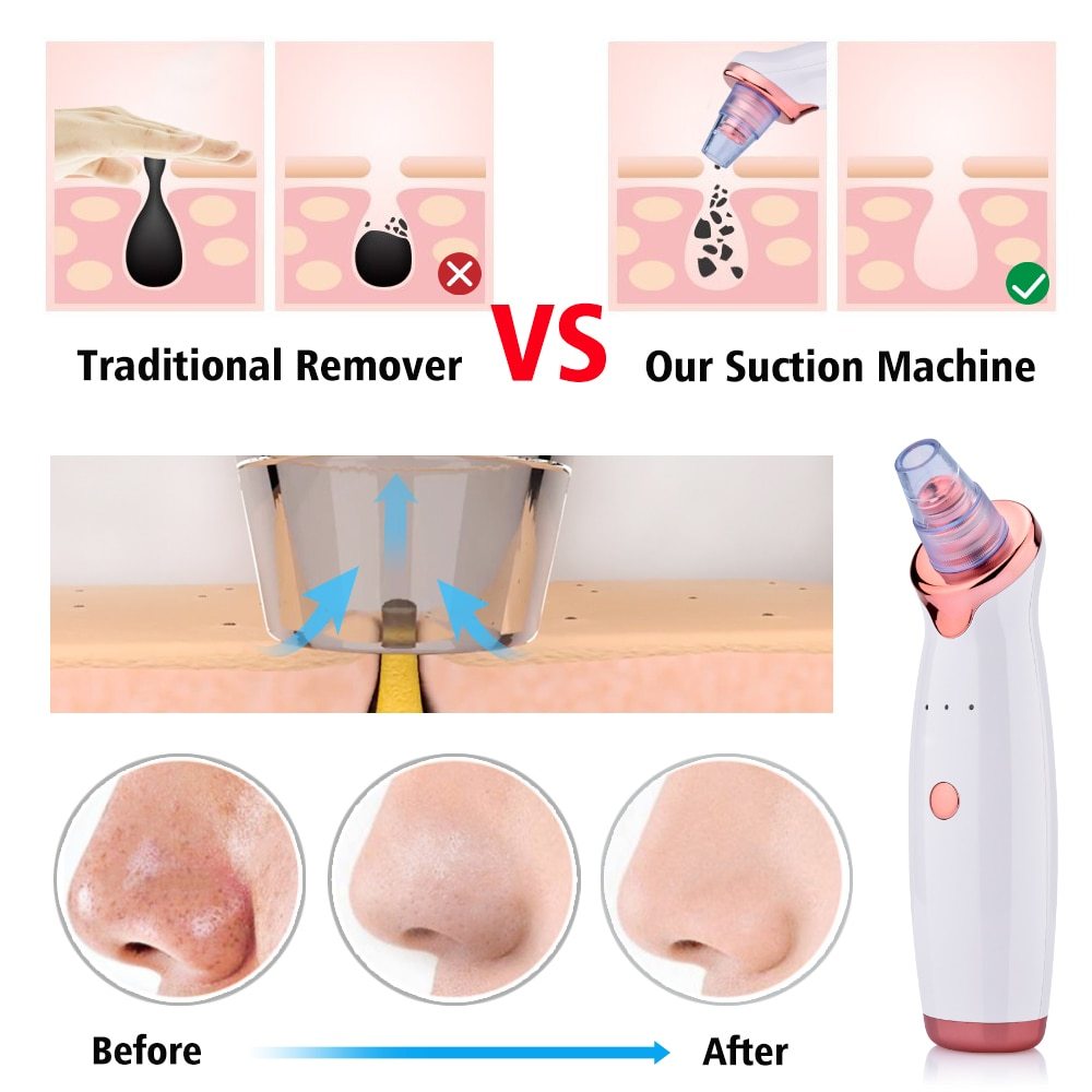 Bye-Bye Blackheads: Electric Acne & Pore Suction Tool